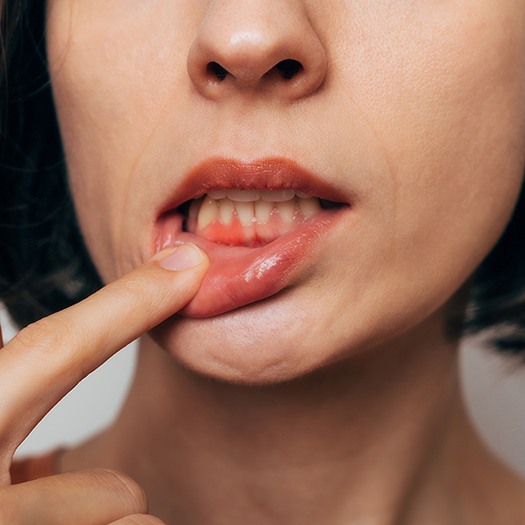dental implants can fail due to a variety of issues including peri-implantitis