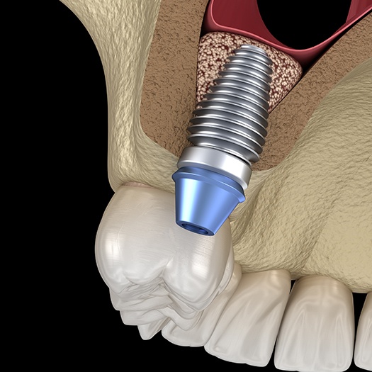 Dental implant salvage works by repairing any underlying damage before reimplanting your dental implant