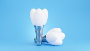Image of two dental implants on a blue background